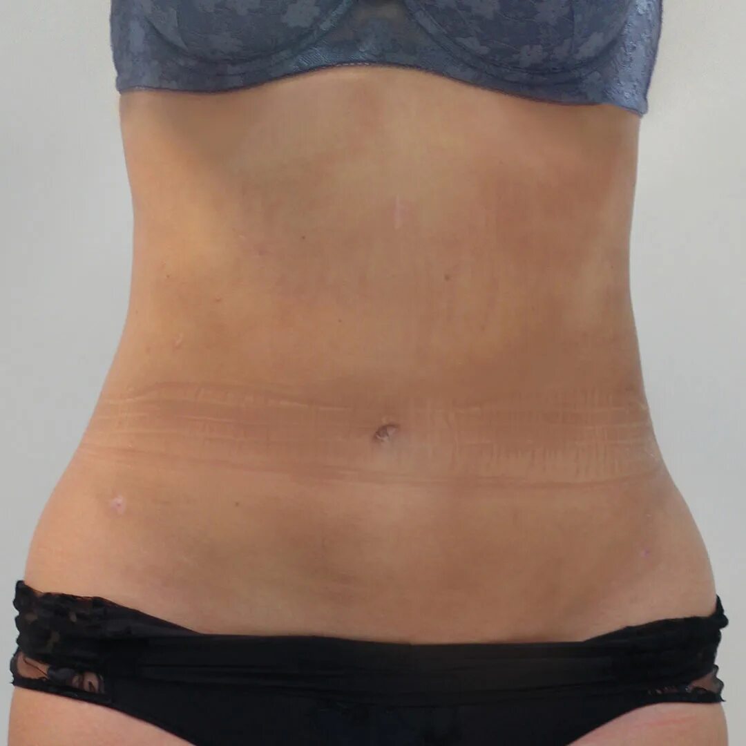 лазерный липолиз живота. отвисшая кожа после похудения. липосакция живота и боков. лазерный липолиз живота. мини абдоминопластика шрамы.