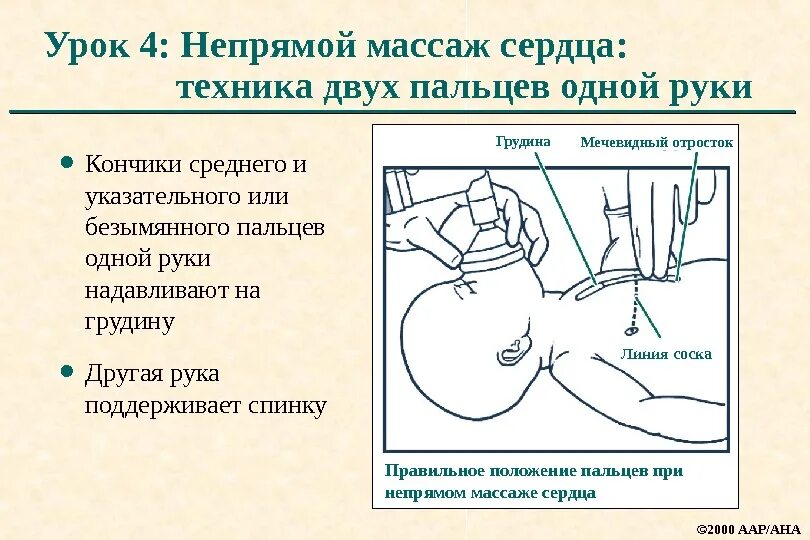 Непрямой массаж сердца схема. Непрямой массаж сердца т. Методика непрямого массажа сердца. Схема проведения непрямого массажа сердца. Частота закрытого массажа сердца