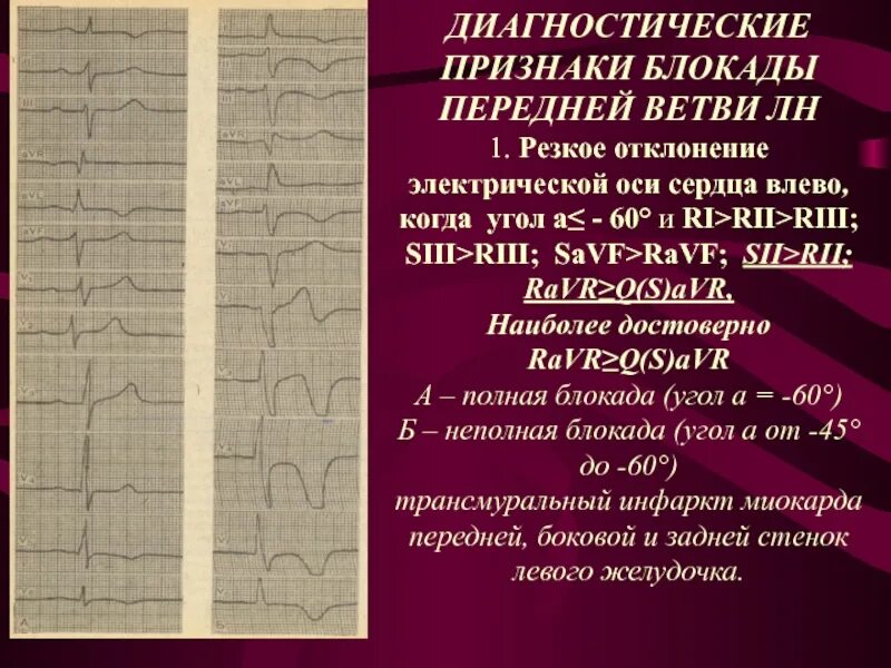 Смещение эос влево. Диагностическая блокада. отклонение оси влево на экг. отклонение эос влево, блокада передней ветви левой ножки пучка гиса;. эос при блокаде правой ножки пучка гиса.