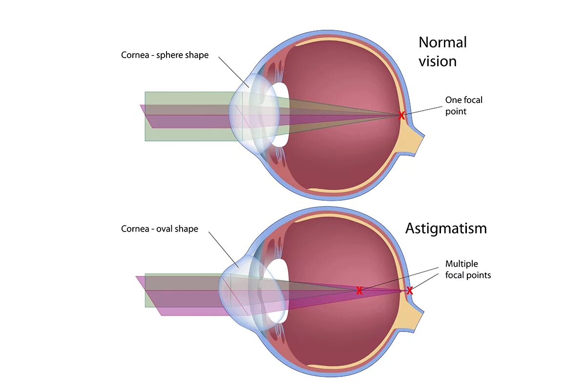 С точки зрения наличия в. Глазная болезнь астигматизм. Строение глаза при астигматизме. Нормальный глаз и астигматизм. Форма роговицы при астигматизме.