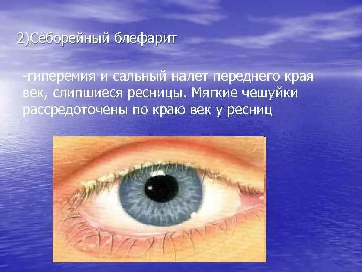 Ресничный край века. Переднекраевой блефарит. Блефарит Моракса Аксенфельда. Хронический блефарит век.