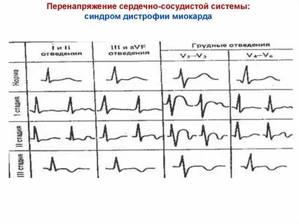 Экг у спортсменов