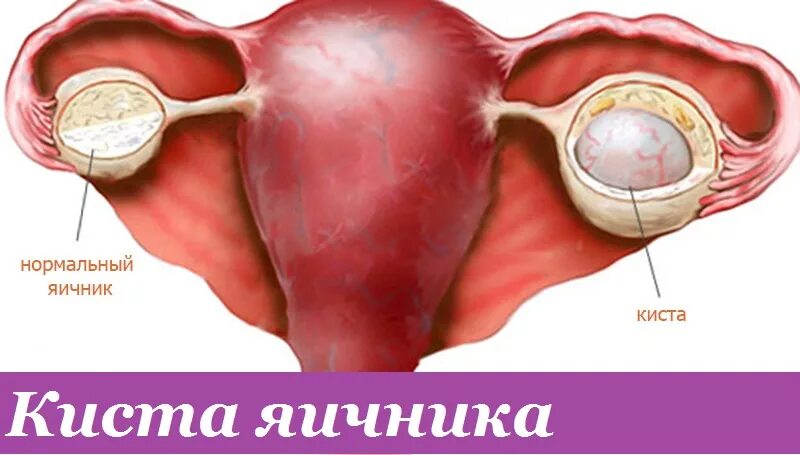 Киста 17 мм