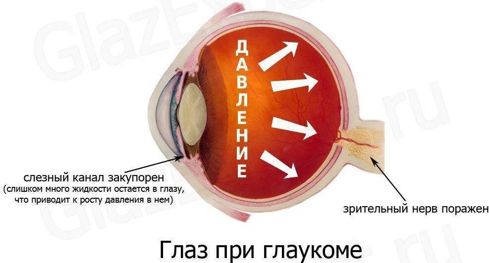 Глазное давление при катаракте. Зрение при глаукоме.