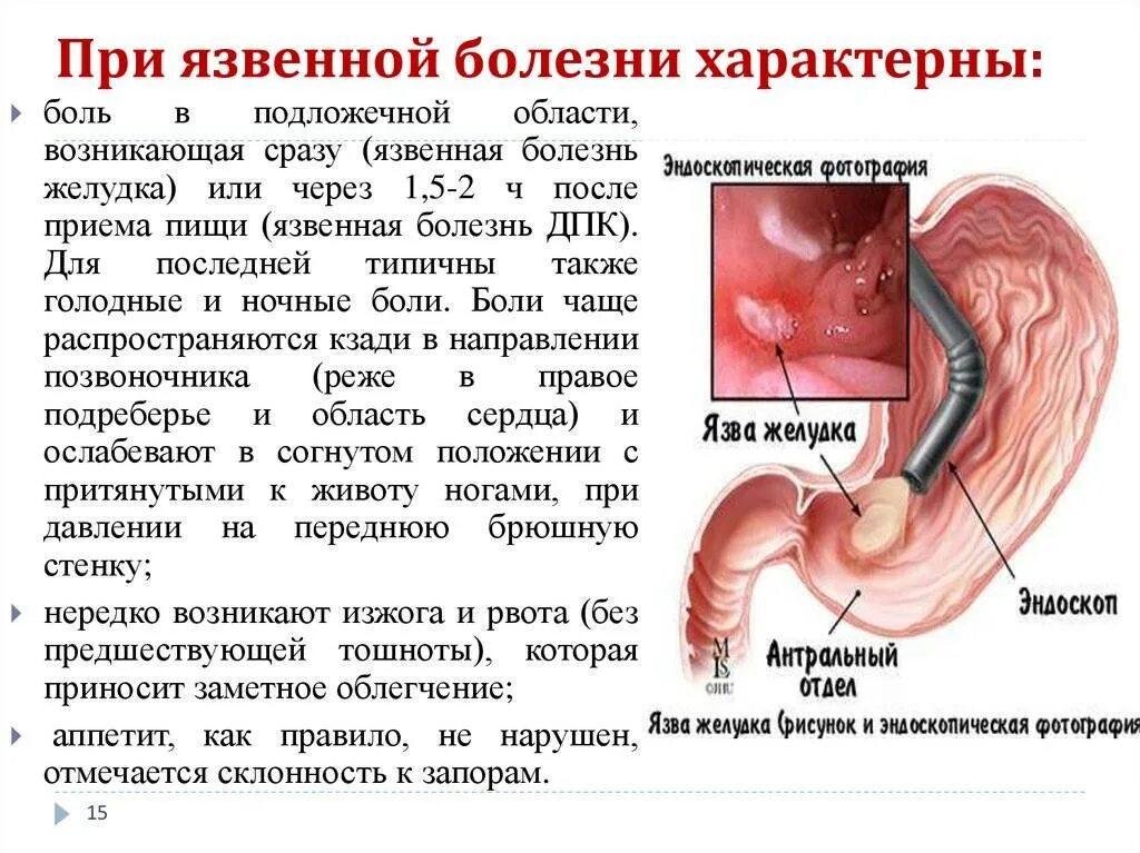 Язвенная болезнь желудка и 12 перстной кишки. Проявления язвенной болезни желудка и 12-перстной кишки.. Язвенная болезнь 12 перстной кишки симптомы. Терапия язвенной болезни 12 перстной кишки. Причина гастрита б