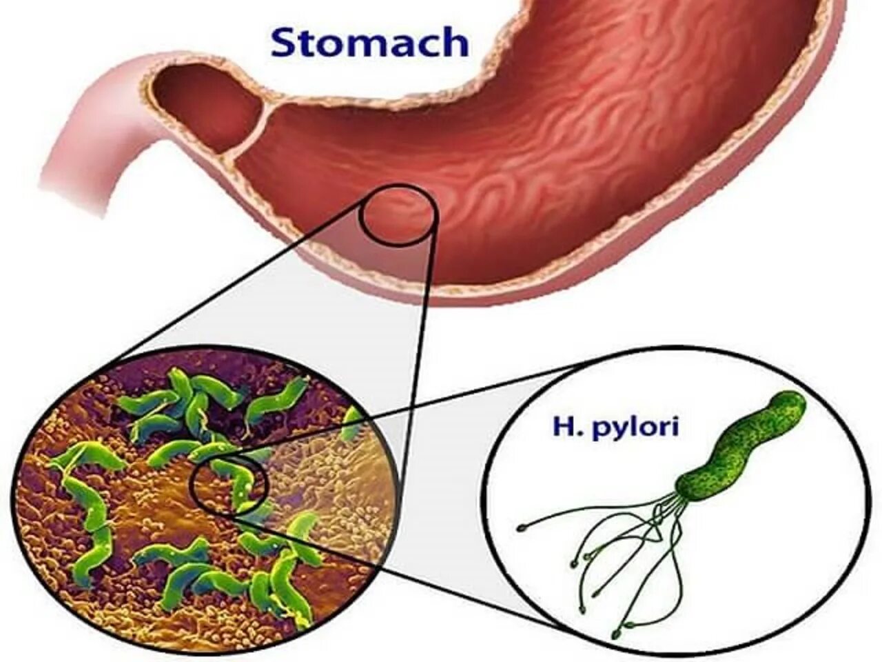 Хеликобактер пилори рисунок. Helicobacter pylori симптоматика. Хеликобактериоз желудка. Роль гастрита