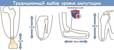 Код ампутации нижних конечностей