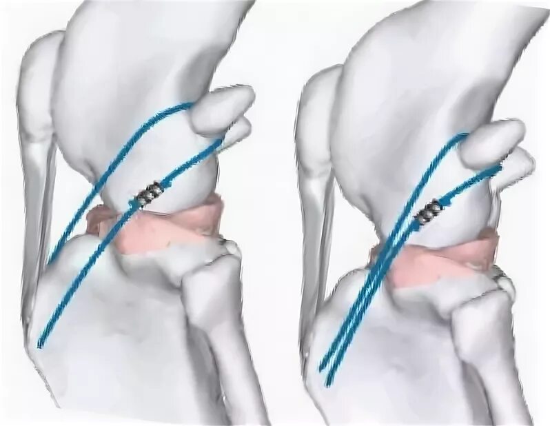 Разрыв связки у собаки. Фабелло тибиальный шов собаки. Фабелла коленного сустава. Фабелло тибиальный шов стабилизация коленного сустава у собак.
