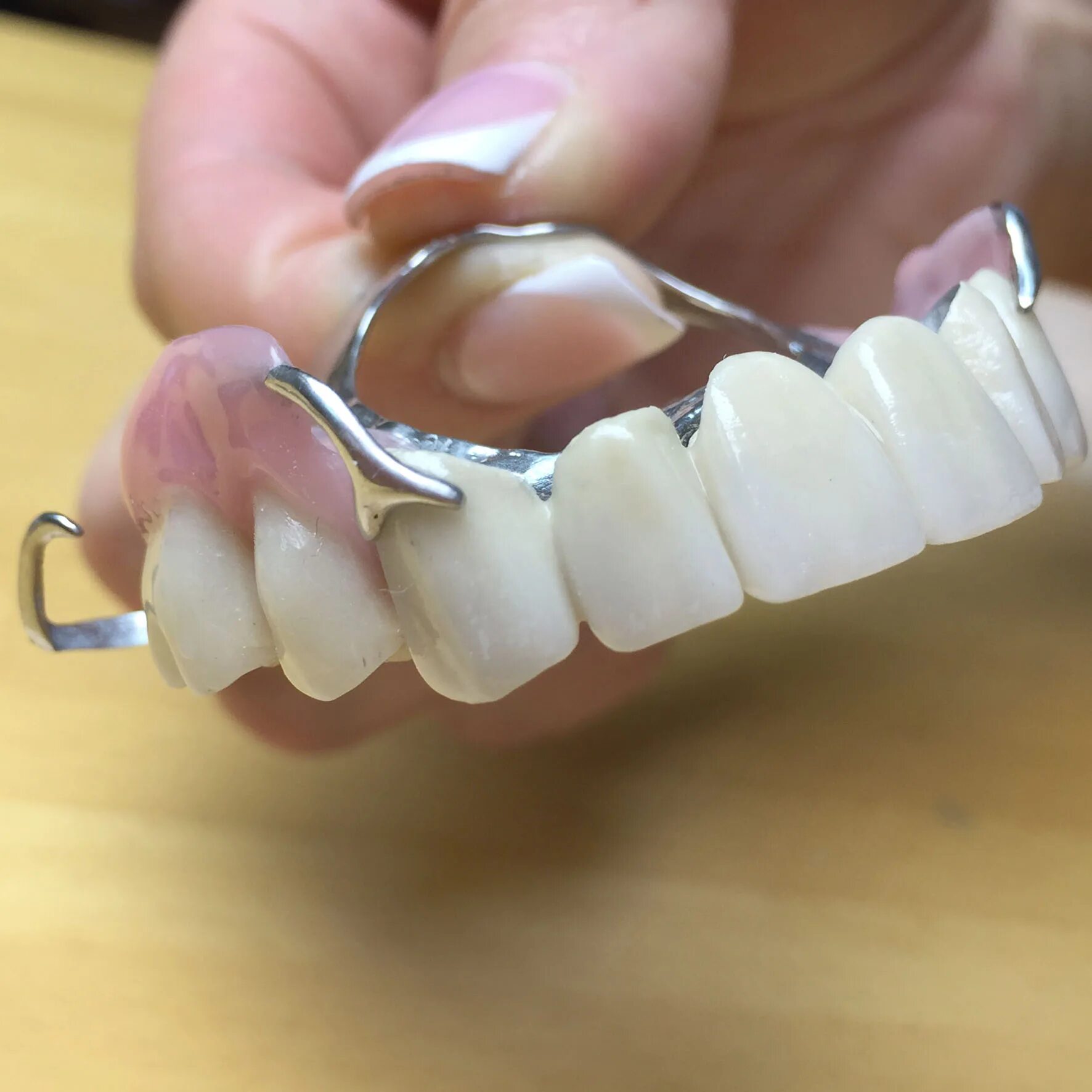 Dental bridge anterior - Upper Anterior Crowns & Lower Anterior Bridge.