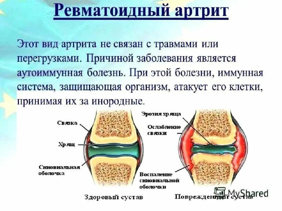 Болезни суставов температура. Формы ревматоидного артрита. Суставы при ревматоидном артрите.