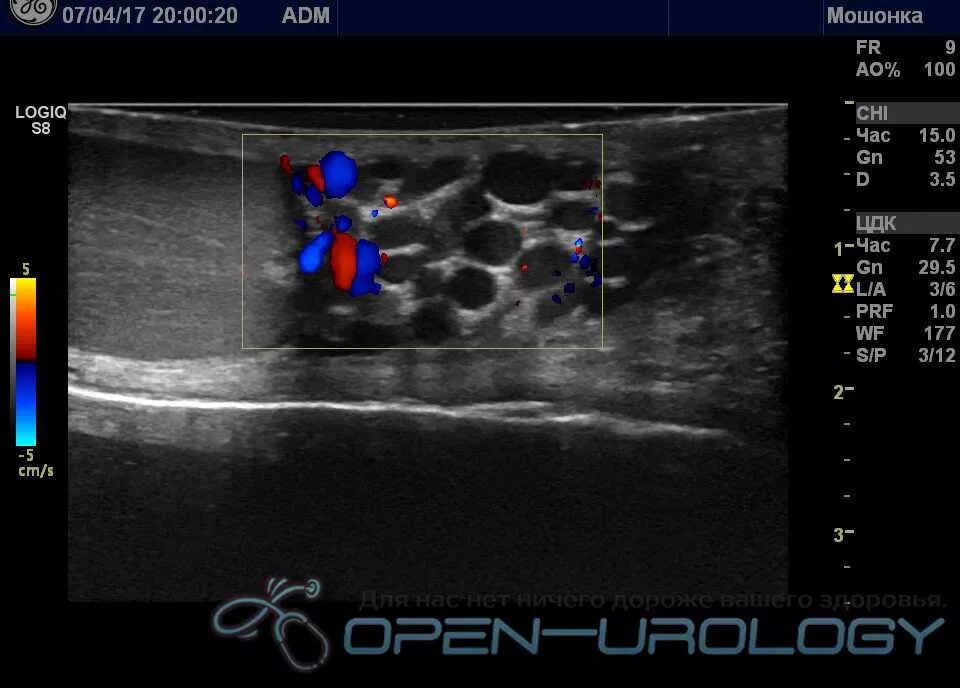 Расширение вен канатика. Варикозное расширение вен семенного канатика на УЗИ. УЗИ мошонки проба Вальсальвы. Вены семенного канатика норма УЗИ. УЗИ органов мошонки + допплерография.