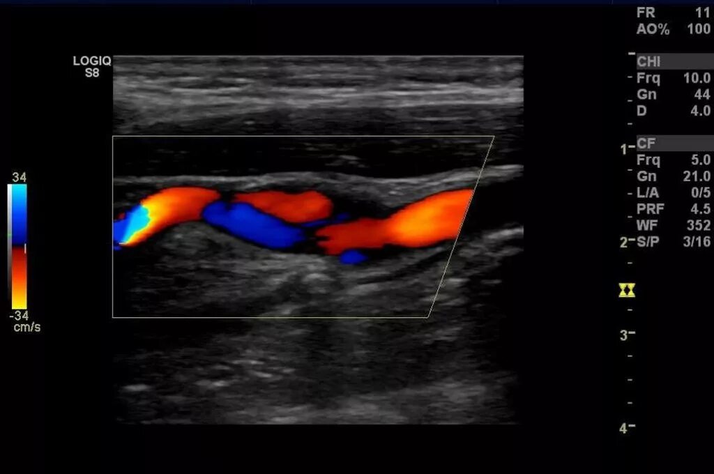 Что такое уздг. Цветное допплеровское картирование брахиоцефальных сосудов. УЗИ сосудов шеи брахиоцефальных артерий что это такое. УЗИ сосудов бца. Ультразвуковое цветовое дуплексное сканирование.