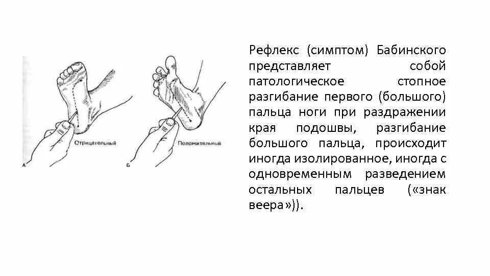 Положительные рефлексы. Патологические рефлексы симптом Бабинского. Положительный рефлекс Бабинского. Разгибательный рефлекс Бабинского. Патологический рефлекс Бабинского при.