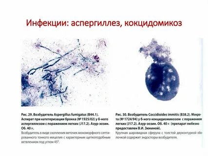Аспергиллез лечение