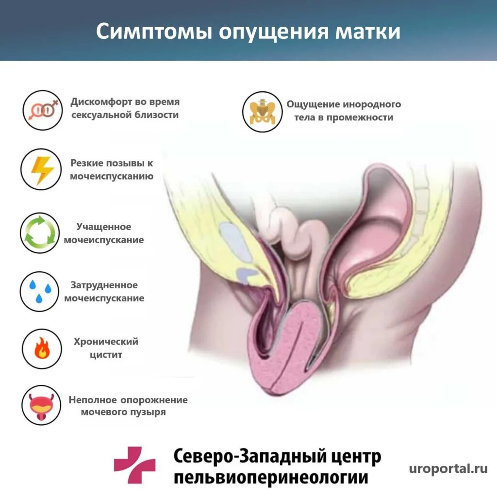 Опущение и выпадение матки. Пролапс матки симптомы. Опущение и пролапс матки.