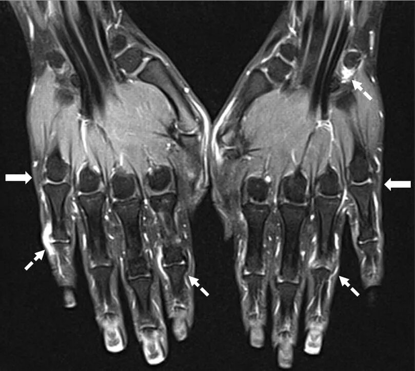 Артрит кт. Ревматоидный артрит мрт. Ревматоидный артрит лучезапястного сустава мрт. Ревматоидный артрит кисти кт. Ревматоидный артрит кистей рук кт.