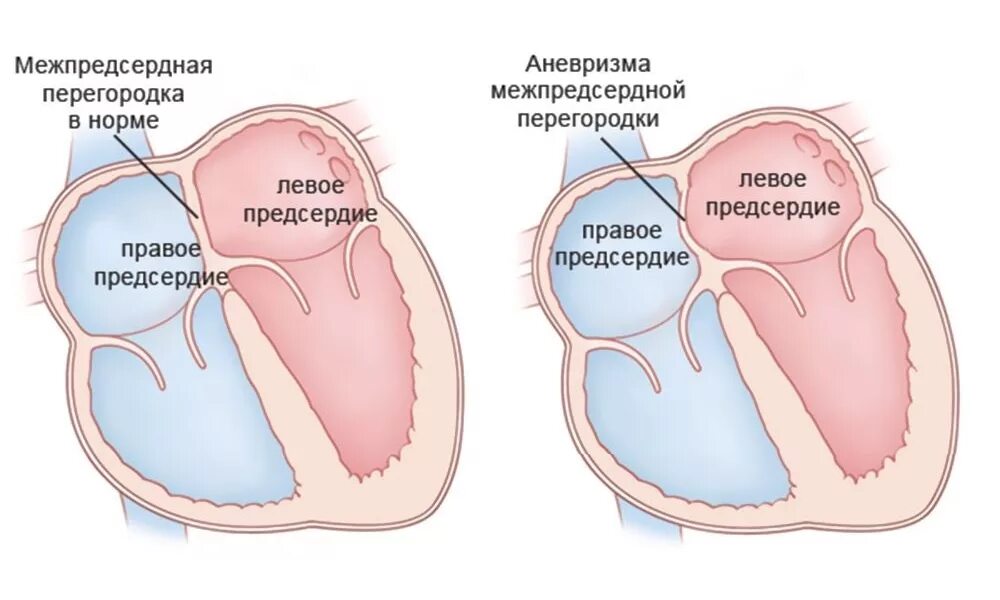 Недостаточность предсердия. Межпредсердная перегородка аневризма. Дефект между предсердной перегородки. Аневризма межпредсердной перегородки на УЗИ.