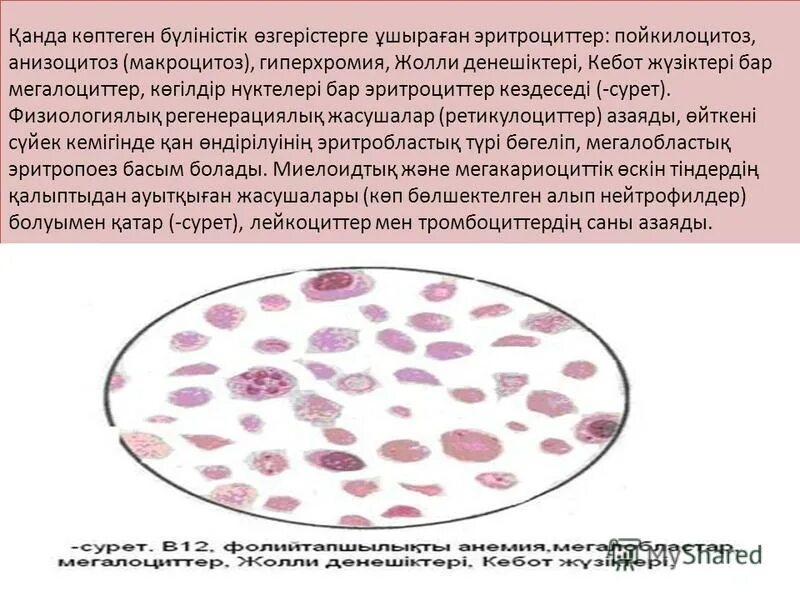 Анизоцитоз микро незначительный