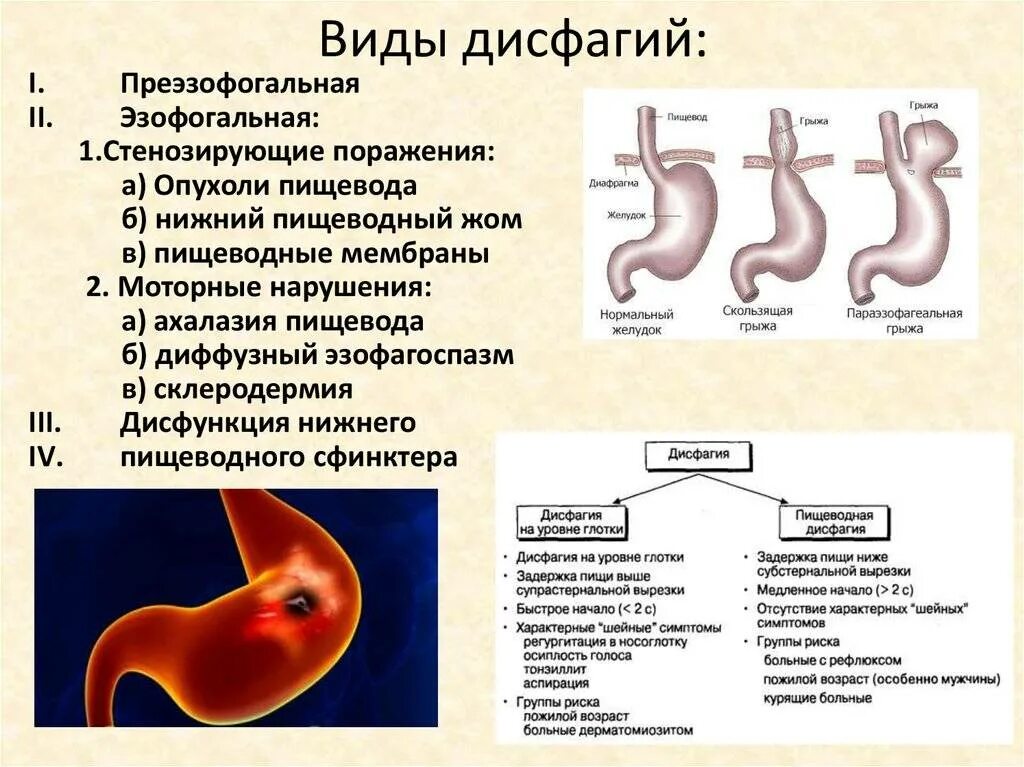 Нарушение функции пищевода. Синдром дисфагии классификация. Синдром дисфагия симптомы. Дисфагия причины возникновения. Пищеводная дисфагия симптомы.