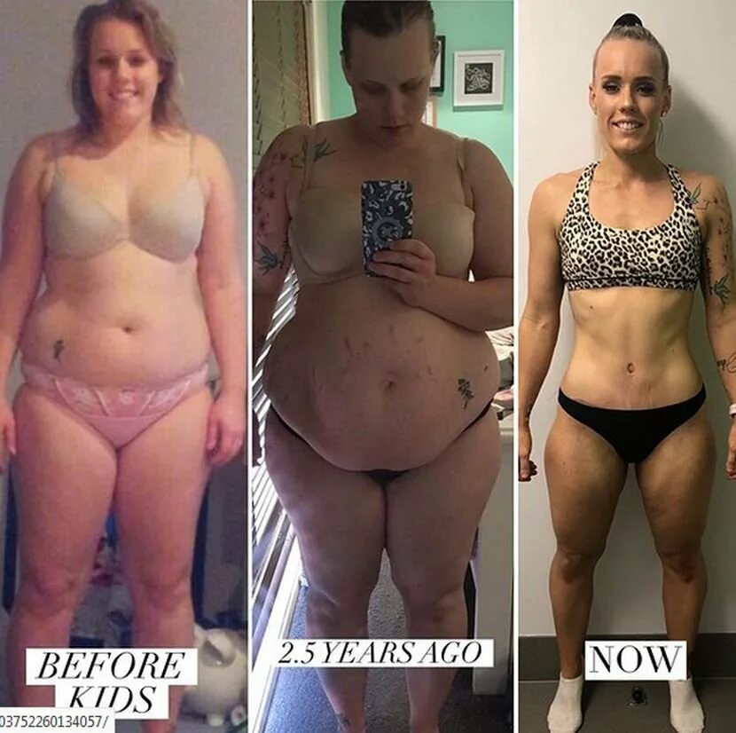 Висит кожа после похудения. Обвисла кожа после похудения. Обвисло после похудения. Обвисшая кожа при похудении. Живот до и после похудения.