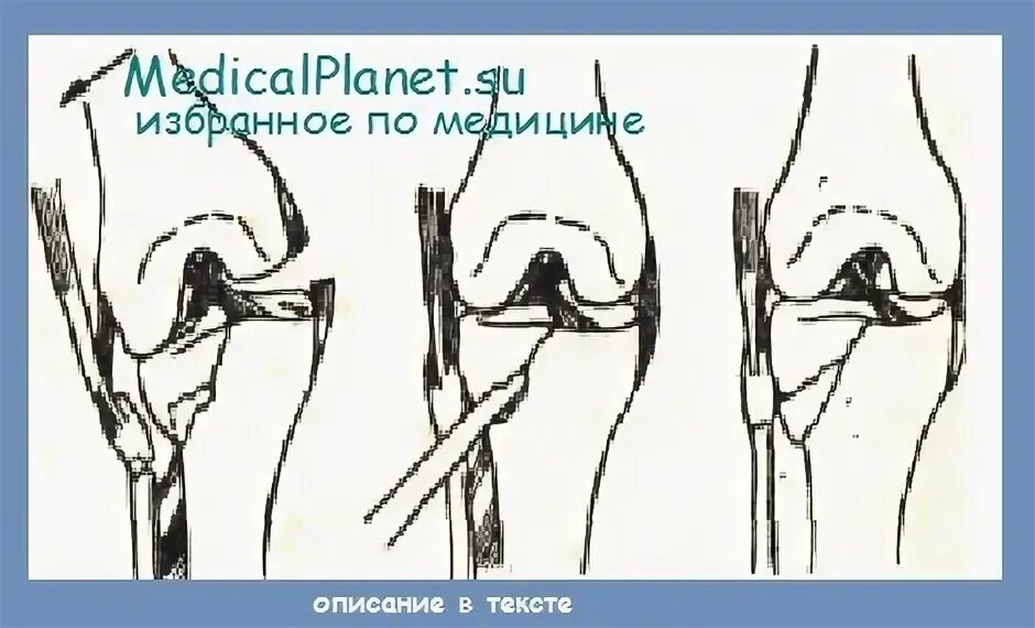 Импрессионный перелом латерального мыщелка бедра. Перелом латерального мыщелка бедренной кости. Импрессионный перелом мыщелка. Повреждение медиального мыщелка большеберцовой кости. Импрессионный перелом мыщелка коленного сустава.