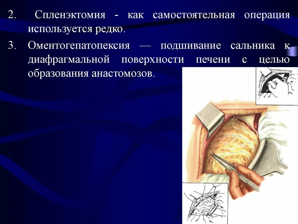 Спленэктомия что это. Спленэктомия презентация. Самостоятельная операция. Портальная гипертензия спленэктомия.