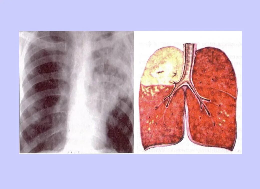 Казеозная пневмония макропрепарат. Казеозная пневмония туберкулез рентген. Казеозная и крупозная пневмония. Казеозная пневмония легких рентген. Легкое течение пневмонии