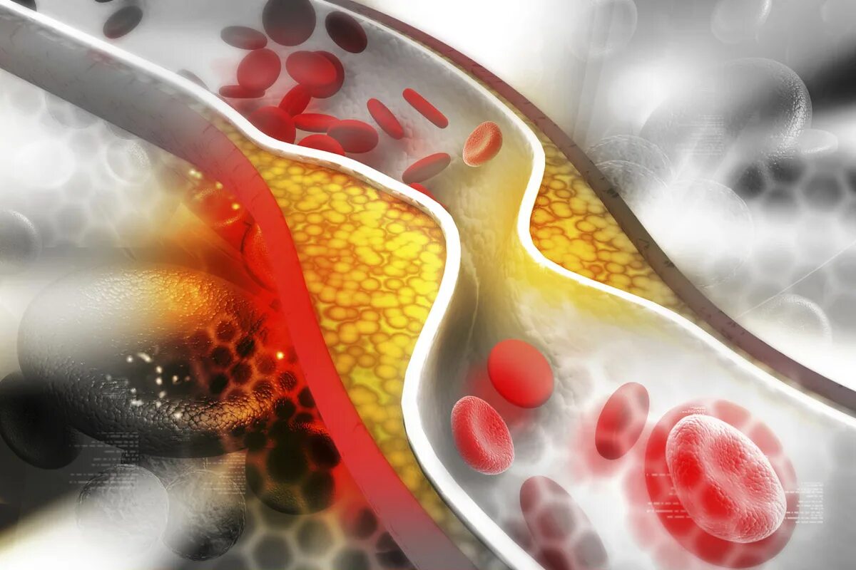 Холестериновые бляшки в сосудах. Повышенный уровень холестерина. Холестерин в крови. Снижение уровня холестерина.