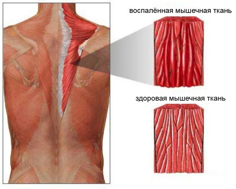 Диффузная мышечная