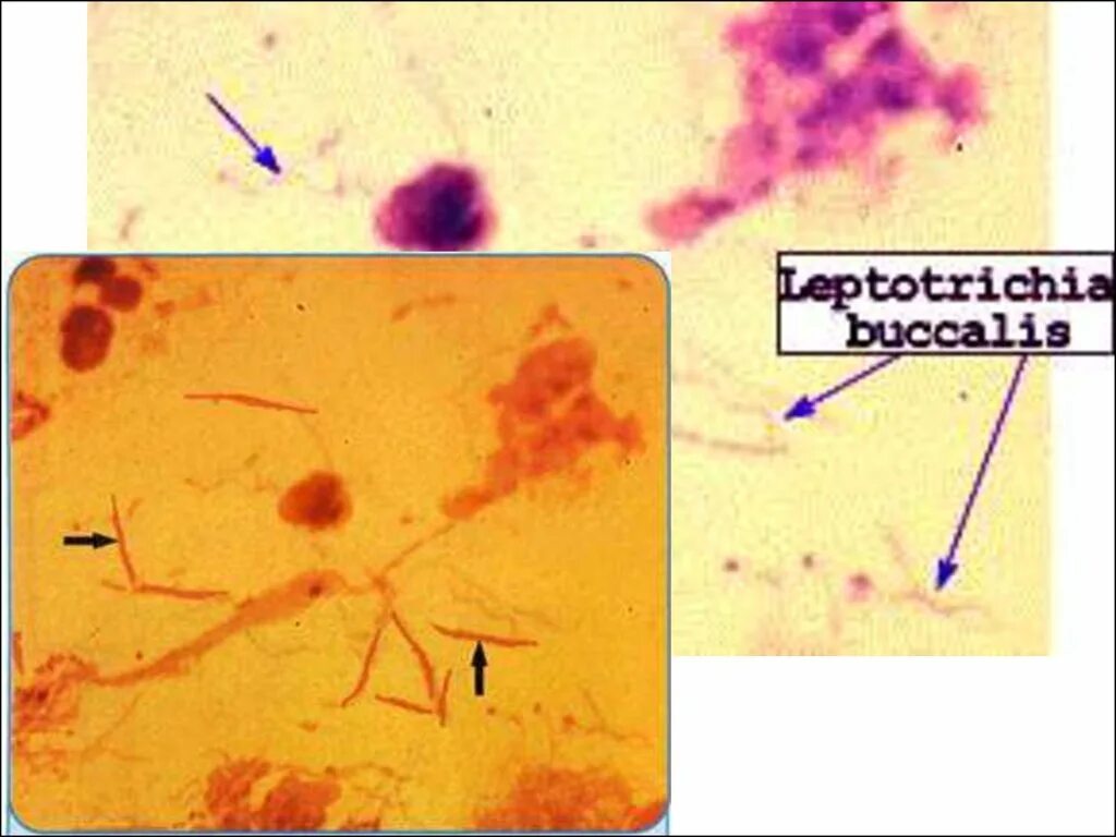 Лептотрикс лечение. Лептотрикс в моче. Лептотрикс микроскопия. Возбудители неклостридиальной анаэробной инфекции. Неклостридиальные анаэробы микробиология.