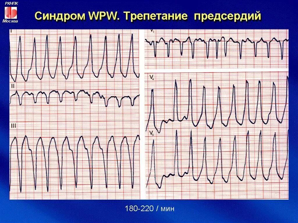 Фибрилляция предсердий с блокадой. Фибрилляция предсердий с синдромом wpw на экг. wpw при фибрилляции предсердий. трепетание предсердий при wpw. фибрилляция предсердий с блокадой правой ножки пучка гиса.