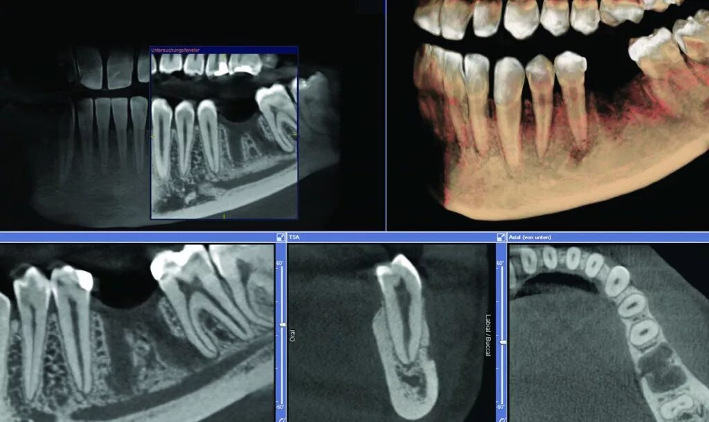 Можно ли с зубным имплантом делать мрт. КЛКТ 8х15. КЛКТ (конусно-лучевая компьютерная томография). Компьютерная томография челюсти снимок. 3д конусно-лучевая компьютерная томография.