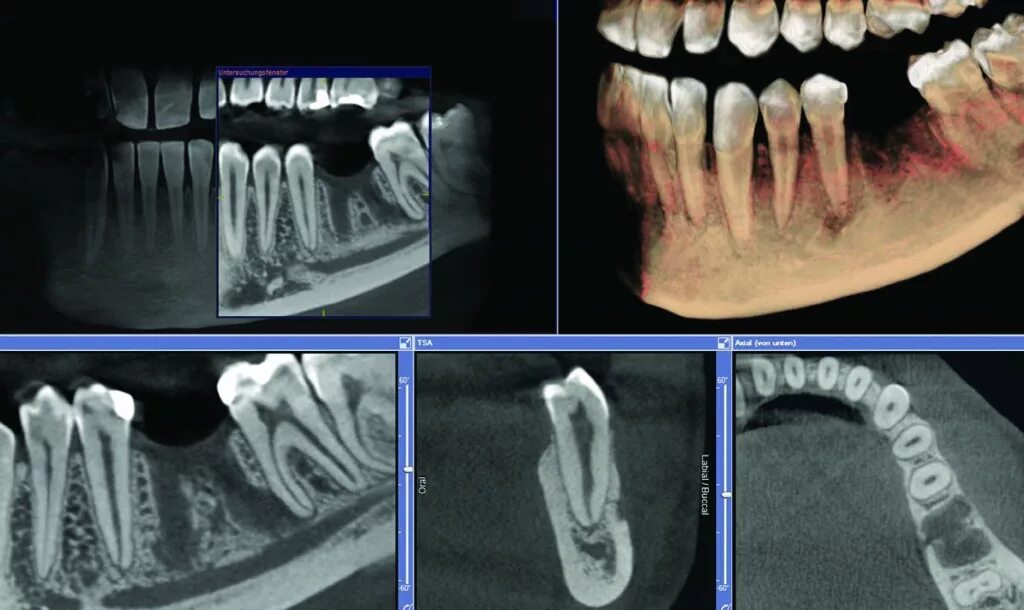 Имплант и мрт можно ли. КЛКТ 8х15. КЛКТ (конусно-лучевая компьютерная томография). Компьютерная томография челюсти снимок. 3д конусно-лучевая компьютерная томография.