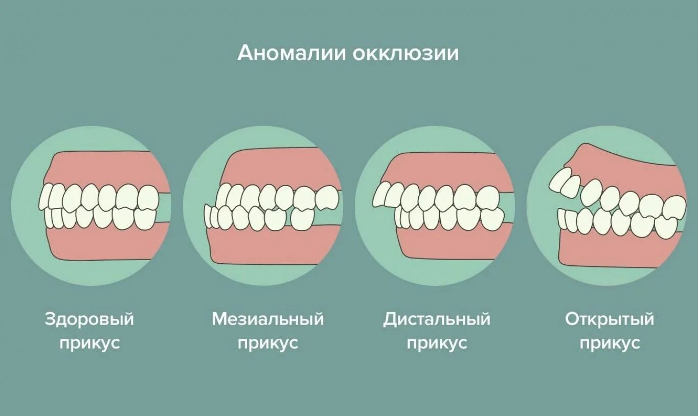 Аномалия 2 степени. Правильный прикус у человека схема сбоку. Правильный прикус зубов у человека схема. Как выглядит неправильный прикус прикус зубов. Правильный и неправильный прикус зубов как выглядит.