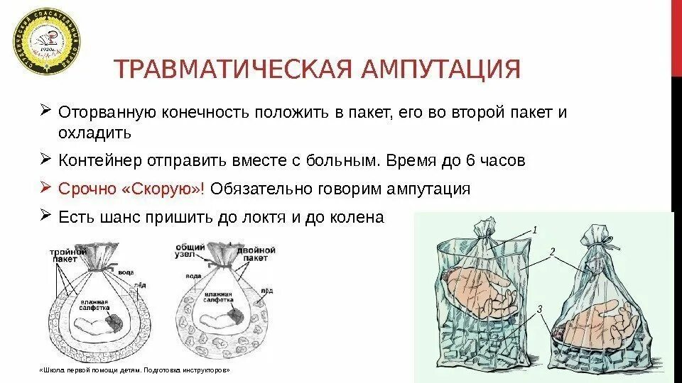 Оказание помощи при травматической ампутации. Травматическая ампутация первая помощь. Травматическая ампутация конечности первая помощь. Травматическая ампутация правой голени. Действия при травматической ампутации