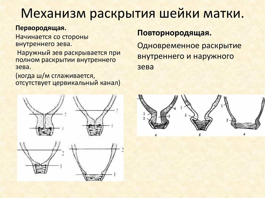 Плотная шейка. Характеристика раскрытия шейки матки. Раскрытие шейки матки при родах механизм. Механизм раскрытия шейки матки у первородящих. Механизм сглаживания и раскрытия шейки матки у повторнородящих.