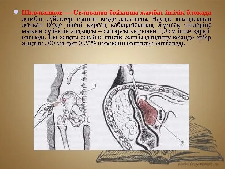 Блокады половые. Тазовая блокада по Школьникову Селиванову. Блокада по Школьникову-Селиванову Цодыксу. Блокада по Школьникову-Селиванову техника. Техника внутритазовой блокады по Школьникову Селиванову.