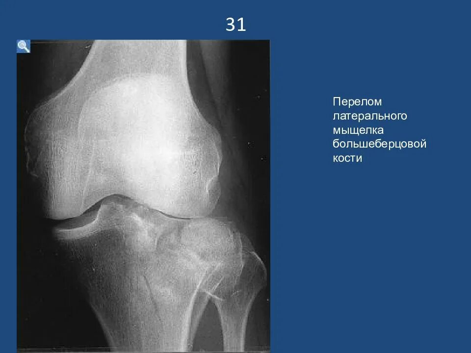 Перелом мыщелков большеберцовой кости рентген. Мыщелка большеберцовой кости. Внутрисуставной перелом медиального мыщелка большеберцовой кости. Импрессионный перелом латерального мыщелка бедра.