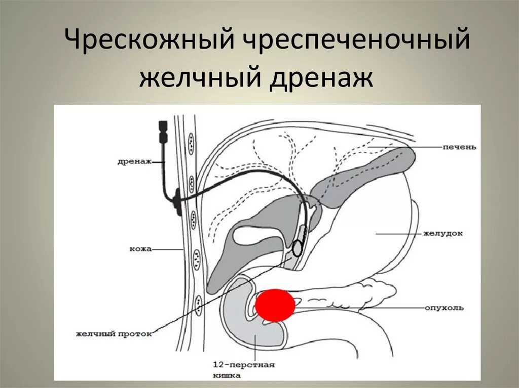 Трубка в желчном пузыре. Наружно внутренний дренаж желчных протоков. Чрескожное чреспеченочное дренирование при механической желтухе. Наружные внутреннее дренирование желчных протоков. Дренирование печеночных протоков.