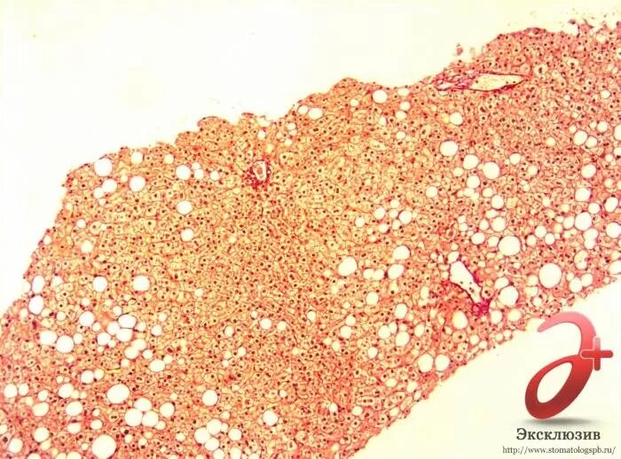 Острая жировая печень. Жировая дистрофия печени у беременных. Жировая дистрофия печени микропрепарат. Острая жировая дистрофия печени. Холестаз печени микропрепарат.