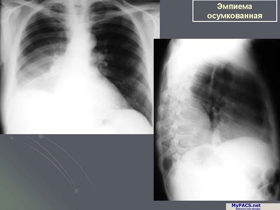Эмпиема легкого. Осумкованная эмпиема плевры рентген. Эмпиема плевры осумкованный гидроторакс. Эмпиема легких рентген. Осумкованный плеврит рентген.