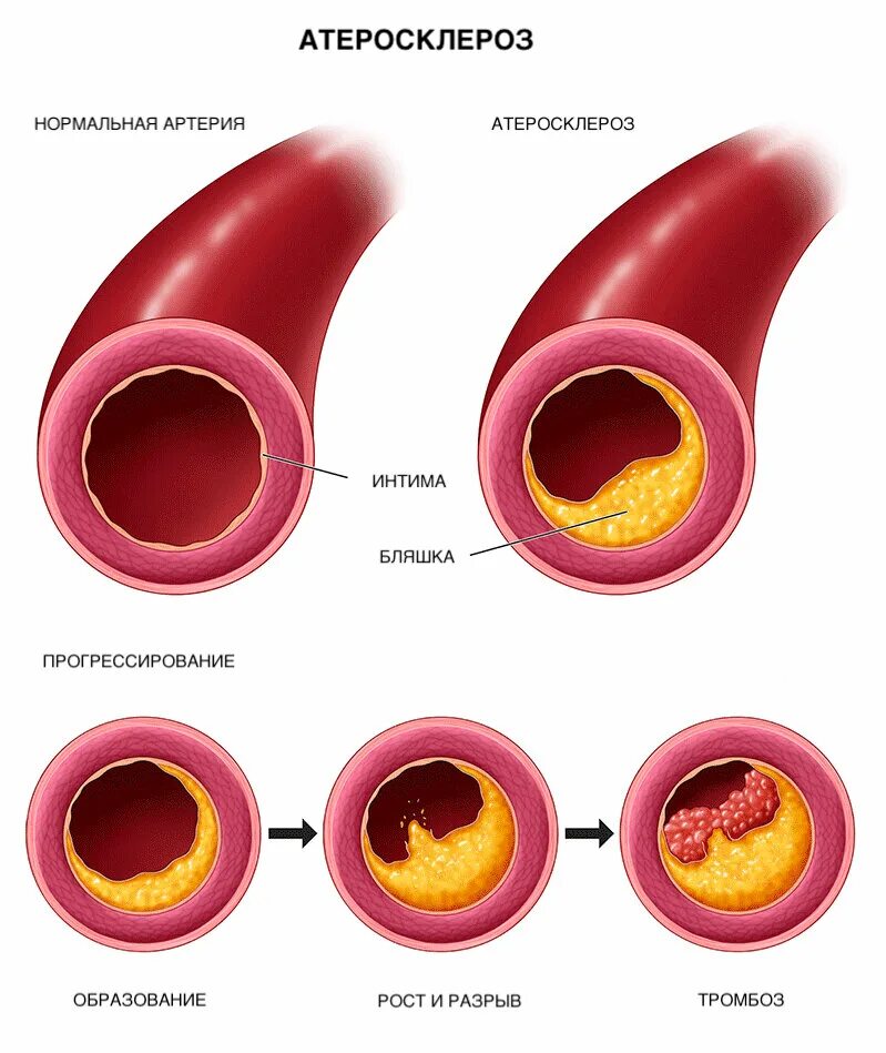 Сильнейший атеросклероз. Атеросклероз и артериосклероз различия. arteriosclerosis.