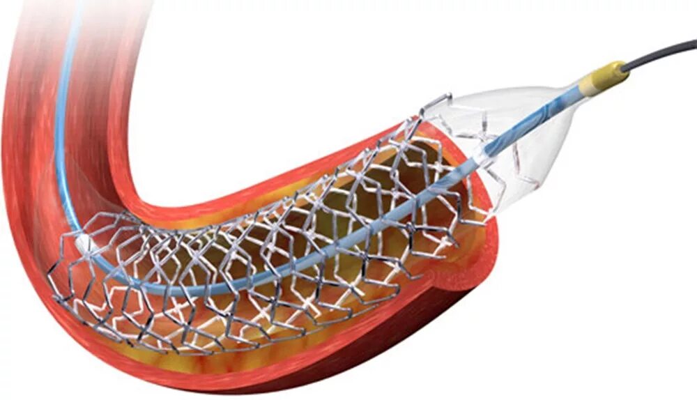 Стент SUPRAFLEX. Стентирование коронарных артерий. Шунтирование и стентирование. Стентирование сосудов сердца. Стентирование рекомендации