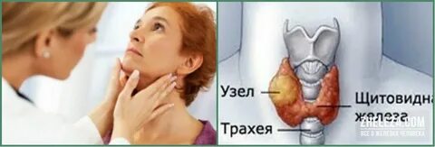 Отзывы удаливших щитовидную железу