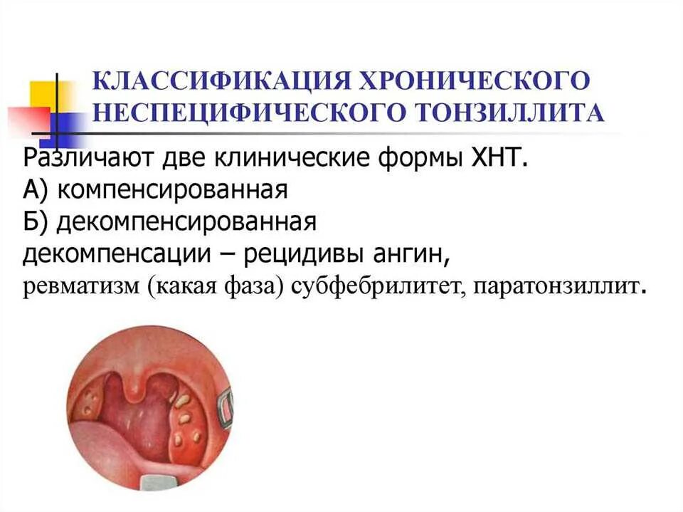 Тонзиллит лечение у взрослых хронический как вылечить. Хронический тонзиллит лакунарный. лакунарная ангина паратонзиллит. хронический тонзиллит субкомпенсация. калькулезный тонзиллит.