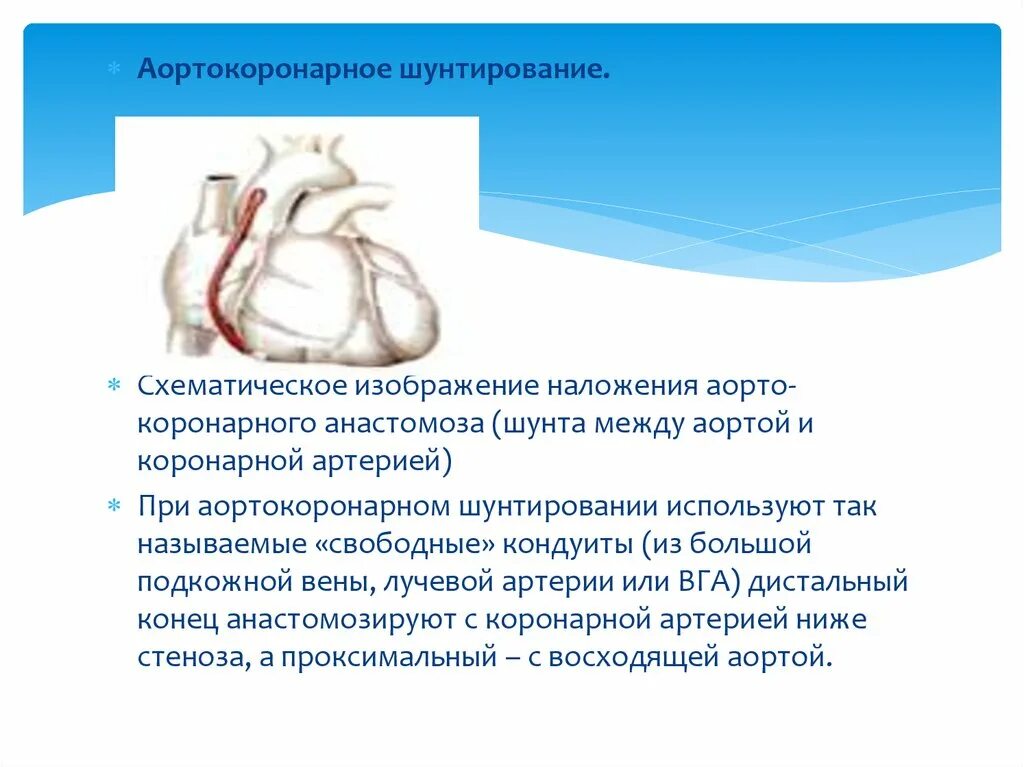 Операции коронарных артерий. Маммарно коронарное шунтирование. Алртно коронарное шунтирование. Аррто коронареое шунтирование. Аортокоронарное шунтирование внутренняя грудная артерия.