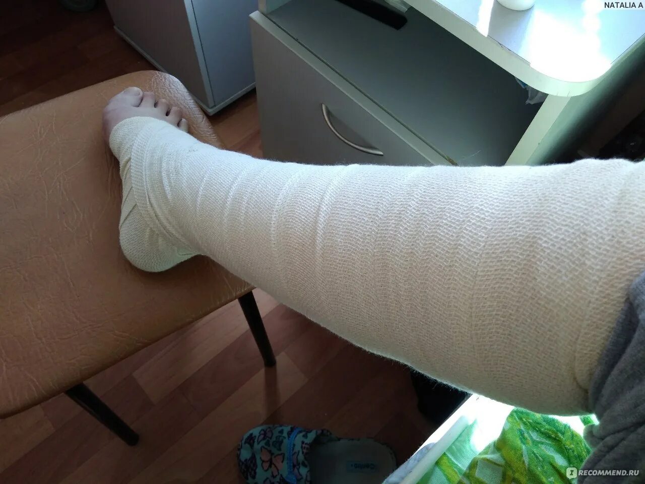 Гипсовая повязка перелом лодыжки. Гипс после операции. Гипс после операции. Перелом берцовой кости гипс. Пластиковый гипс на стопу.