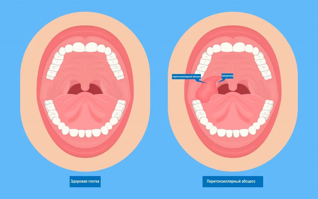 Ангина паратонзиллярный абсцесс. Околоминдаликовый абсцесс. Локализация паратонзиллярного абсцесса. Глоток неприятно