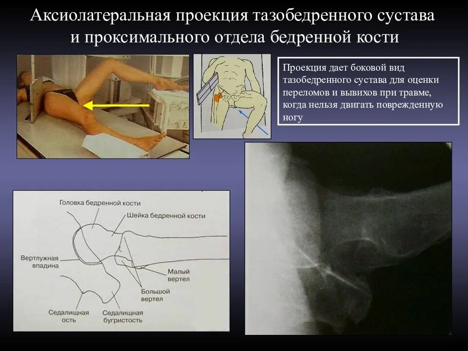 Рентген тазобедренный в двух проекциях. Аксиальная проекция тазобедренного сустава. аксиальная проекция тазобедренного сустава укладка. рентген тазобедренного сустава в аксиальной проекции. аксиальная проекция бедренной кости.