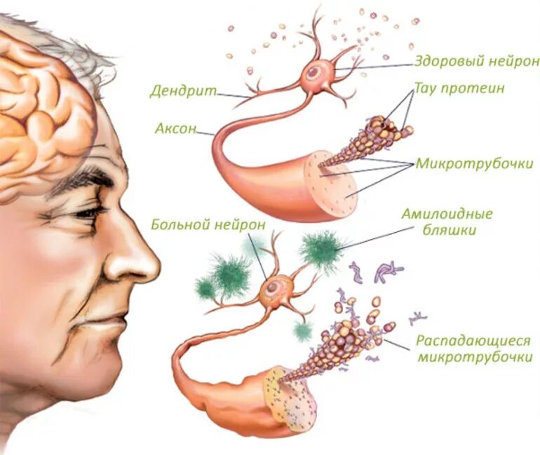 Мозг слабоумие. Механизм развития болезни Альцгеймера. Болезнь Альцгеймера патогенез. Патогенез болезни Альцгеймера схема. Болезнь Альцгеймера этиология.